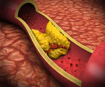 El bezafibrato impide la obstrucción de arterias o arterioesclerosis.