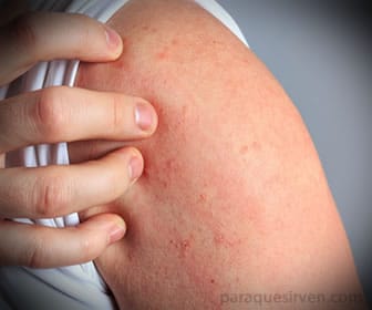 La cetirizina reduce reacciones alérgicas, como la dermatitis atópica.